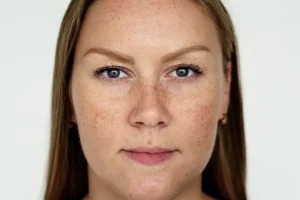 Pigmentation Treatment in Ludhiana