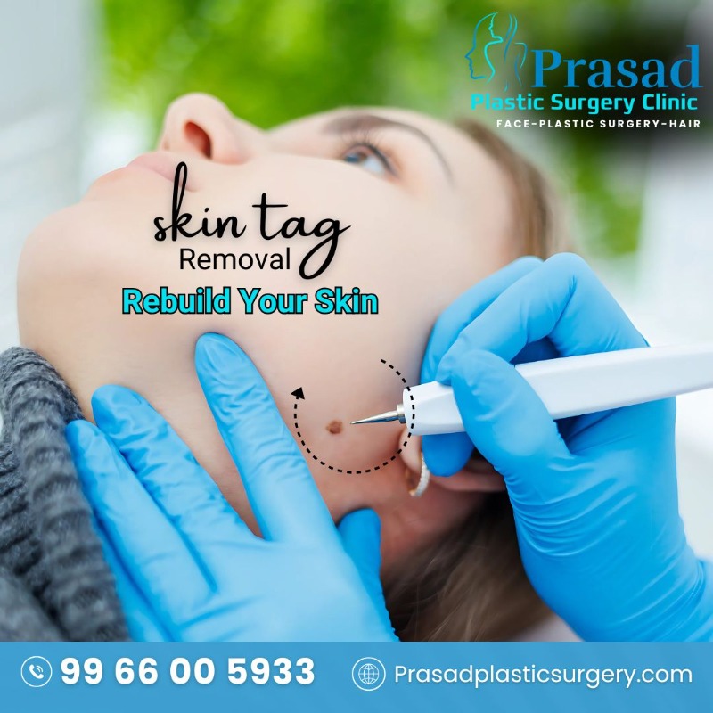 Skin Tag Removal Treatment in Visakhapatnam