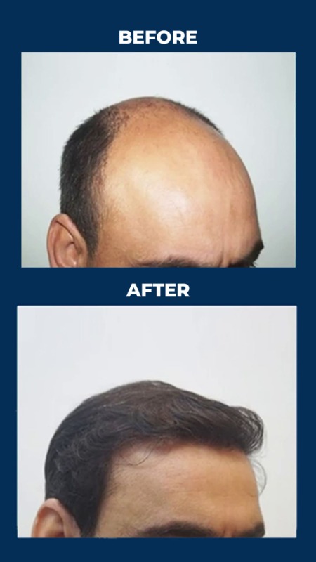 Best Cosmetic Surgeon Hyderabad | Personiks Skin & Hair Care
