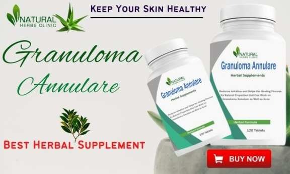 Herbal Supplement for Granuloma Annular
